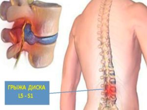 Грыжа l1-l2