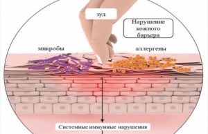 Не могу вылечить дерматит причины