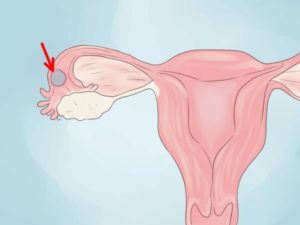 Гистология после внематочной беременности
