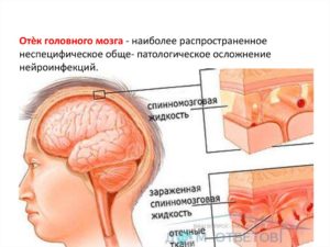 Отек головного мозга