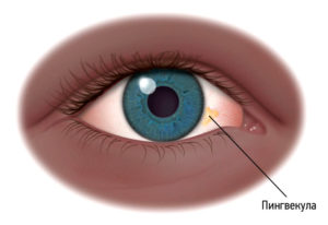 Образование на глазном яблоке