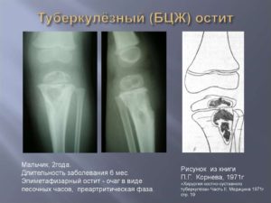 Остеомиелит и прививки