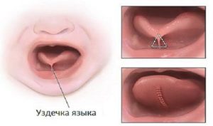 Нужно ли подрезать уздечку ребенку