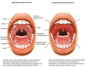 Обострение хронического тонзилита после ОРВИ