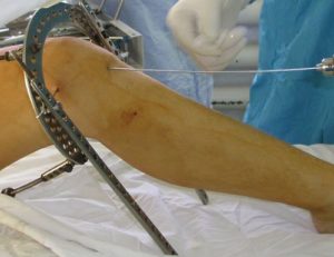 Осложнение после перелома голени и операции с установлением титановой пластины
