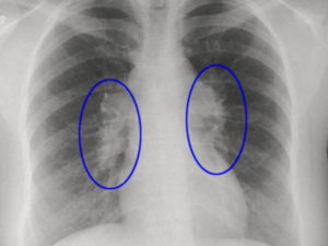 Отчего осталась тень в легком после лечения пневмонии