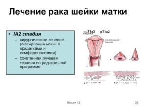 Гиповаскулярное образование на культе шейки матки