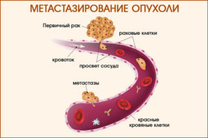 Онкология, рецедив, гиперактивное распространение опухоли