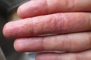 Недолеченный грибок на пальцах рук в виде водянистых пузырьков