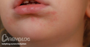 Небольшая сыпь на подбородке и у носа у ребенка 7 лет