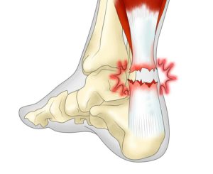Осложнения после разрыва ахилла