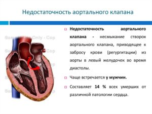 Недостаточность аортального клапана - насколько это страшно?