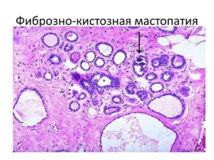 Фиброзно-кистозная мастопатия