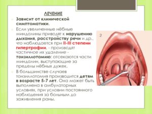 Гипертрофия миндалин 3 степени и подрезание