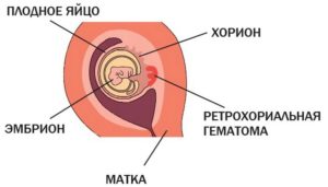 Гематома при беременности