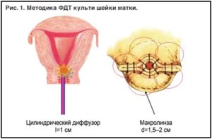 Гиповаскулярное образование на культе шейки матки