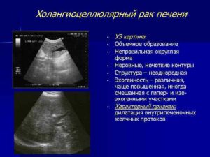 Объемное образование левой доли печени