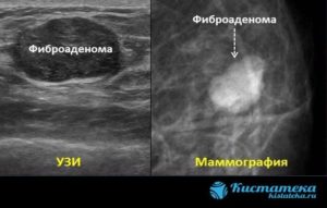 Фиброаденома, изменения на маммографии и узи молочных желез