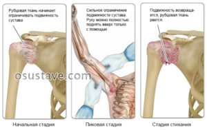 Ограниченная подвижность плеча