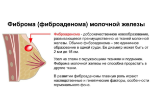 Фиброаденома под вопросом