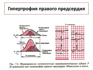 Гипертрофия правого предсердия