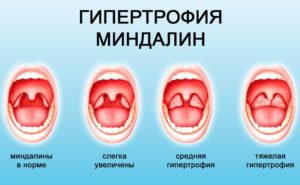 Гипертрофия миндалин 3 степени и подрезание