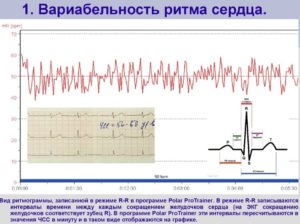 Паузы в сердечном ритме у ребенка