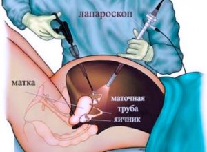 Отек лобка после лапароскопии