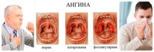 Не проходит кашель, долго красное горло