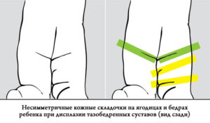 Не симметричные ягодичные складки и левая ножка короче