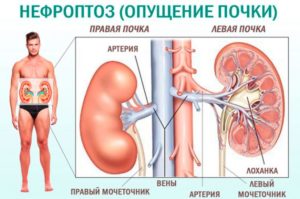 Нефроптоз и его последствия