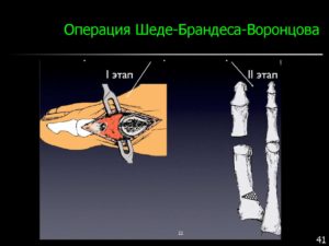 Операция Шэдэ-Брандеса