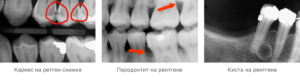 Ноет зуб причины, расшифровка рентген-снимка