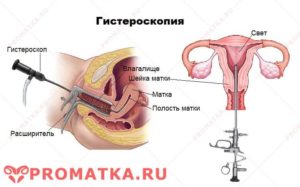 Гиперплазия эндометрия после родов
