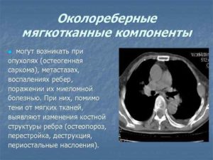 Нужна ли операция по результатам КТ. Пугает название мягкотканный компонент