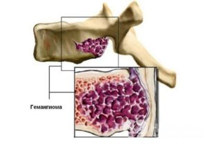 Гемангиома позвоночника