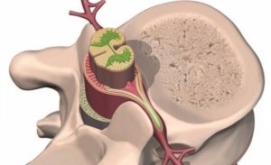 Невринома позвоночника