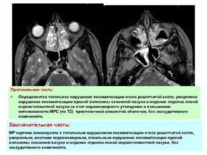 Нерезкое нарушение пневматизации ячеек основной пазухи