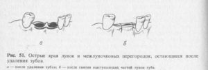 Острая боль и осколок зуба