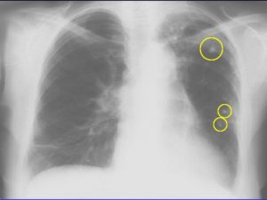 Непонятное образование на флюорографии и рентгене