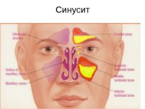 Острый гайморит более 2 месяцев