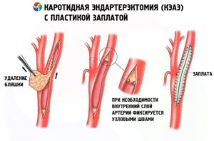 Операцию делали сосуды перетягивали