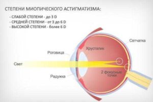 Головная боль миопический астигматизм