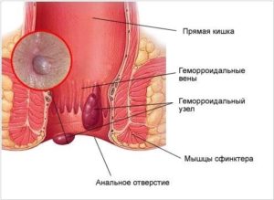 Фиолетовый узел около анального сфинктера