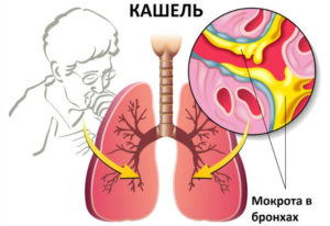 Образование в легких, сильный кашель