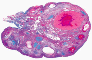 Гистология кисты яичника