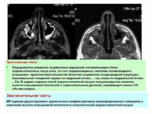 Нерезкое нарушение пневматизации ячеек основной пазухи