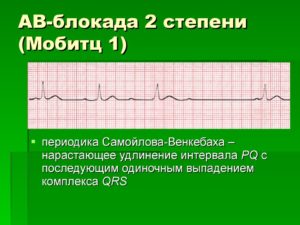 Неполная АВ-блокада 1 степени