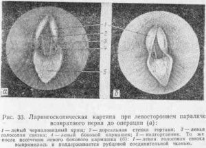 Парез возвратного нерва