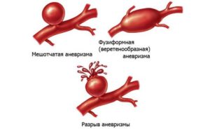 Фузиформная аневризма